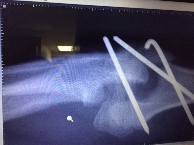 Broken elbow, 12 weeks old