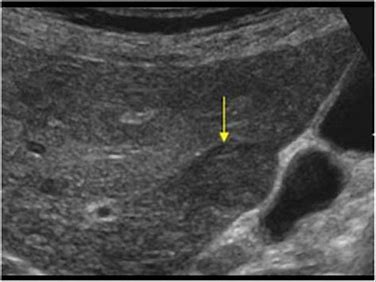 Ultrasound view 